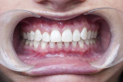 After whitening