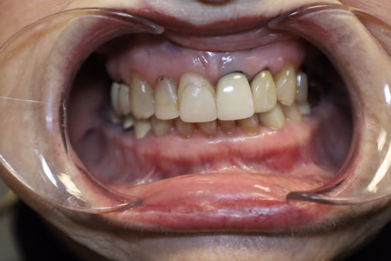Before — Bridges at Nooga Dentistry
