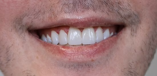 After — Case 3 result at Nooga Dentistry