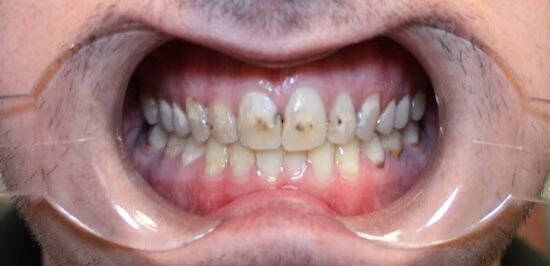 Before — Case 3 at Nooga Dentistry