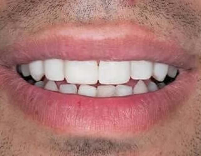 Dental Bonding after