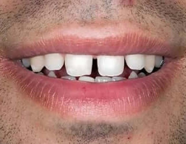 Dental Bonding before