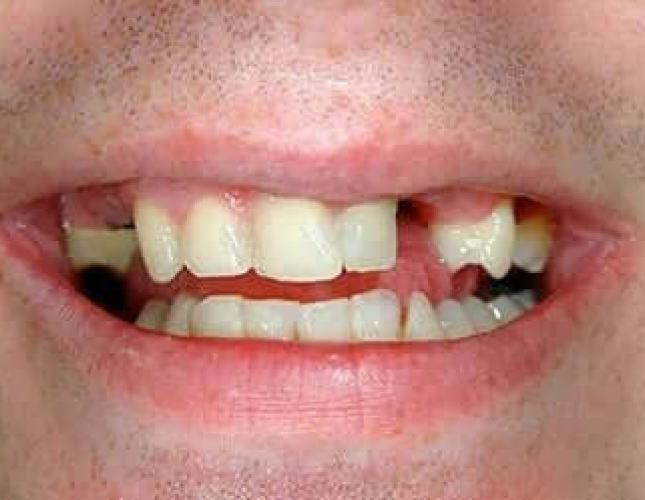 Dental Implants before