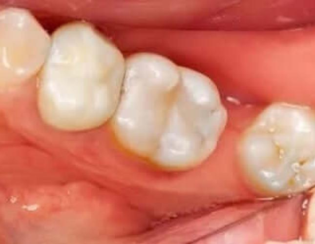 Tooth-Colored Fillings after