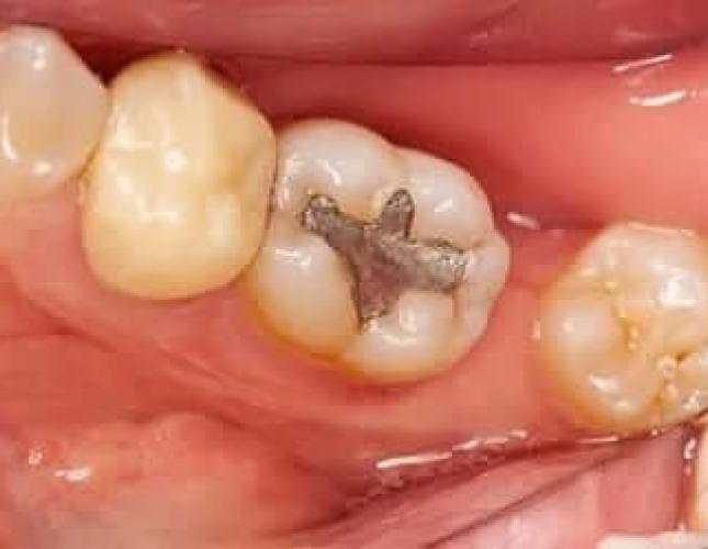 Tooth-Colored Fillings before