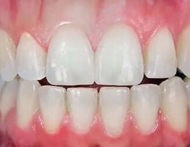 Porcelain Veneers after
