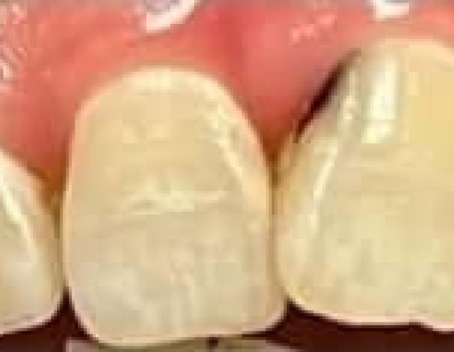 Restorative before