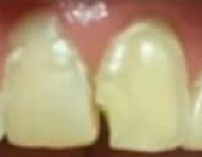 Restorative before
