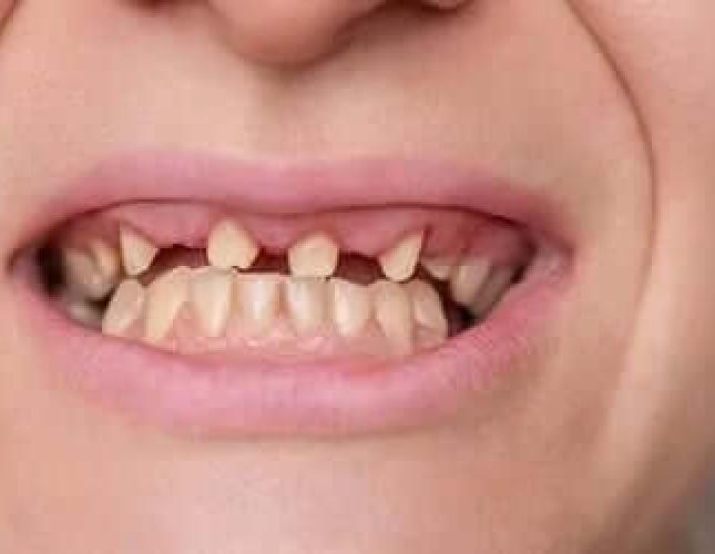 Restorative before