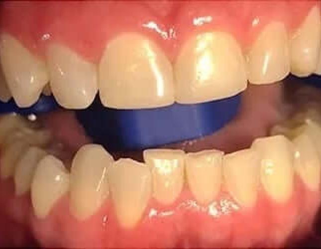 whitening2before.jpg