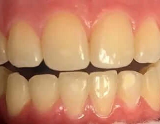 Teeth Whitening before