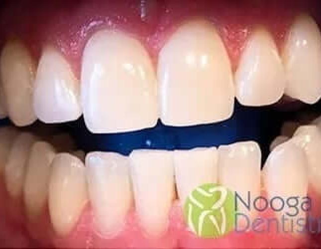 Whitening after